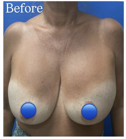 Before Image: Breast Explant Surgery: 8 Months Post Op - front