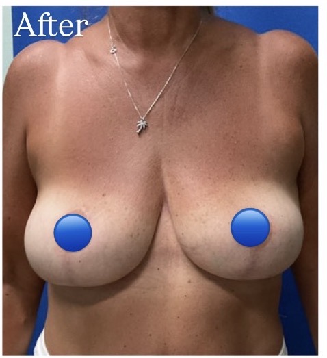 After Image: Breast Explant Surgery: 8 Months Post Op - front
