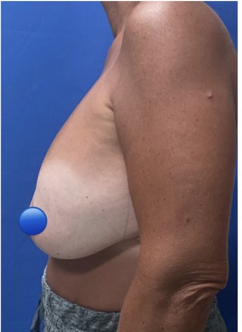 Before Image: Breast Explant Surgery: 8 Months Post Op - left-side