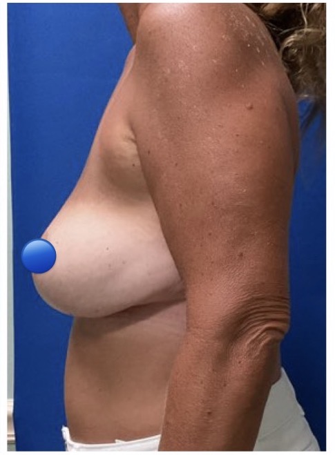 After Image: Breast Explant Surgery: 8 Months Post Op - left-side