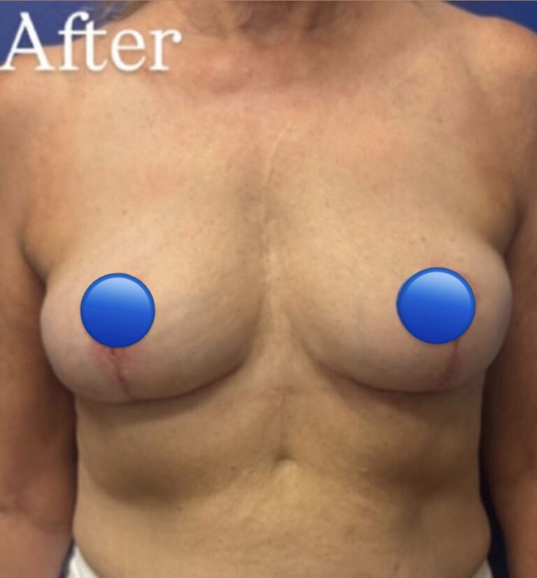 After Image: Breast Explant Surgery: 7 Weeks Post Op - front