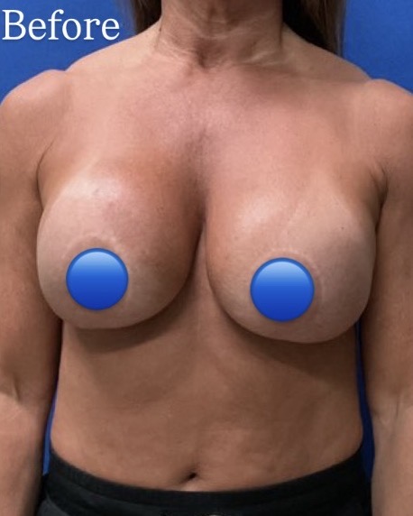 Before Image: Breast Explant Surgery: 5 Weeks Post Op - front