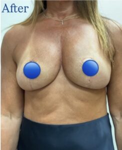 After Image: Breast Explant Surgery: 5 Weeks Post Op