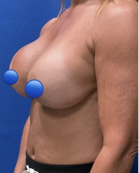 Before Image: Breast Explant Surgery: 5 Weeks Post Op - left-side