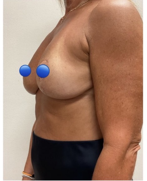 After Image: Breast Explant Surgery: 5 Weeks Post Op - left-side