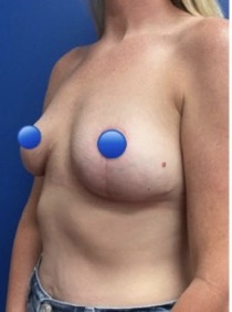 After Image: Breast Explant Surgery: 5 Weeks Post Op
