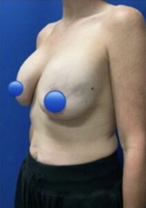 Before Image: Breast Explant Surgery: 5 Weeks Post Op