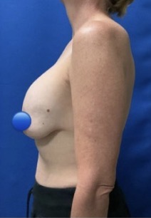 Before Image: Breast Explant Surgery: 5 Weeks Post Op - left-side