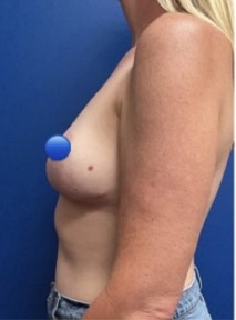 After Image: Breast Explant Surgery: 5 Weeks Post Op - left-side