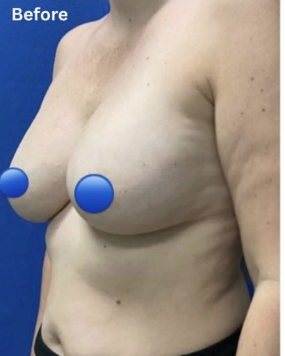 Before Image: Breast Explant Surgery: 5 Weeks Post Op - left-front-oblique