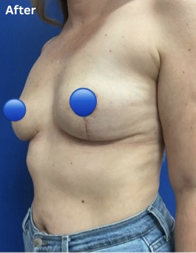 After Image: Breast Explant Surgery: 5 Weeks Post Op - left-front-oblique