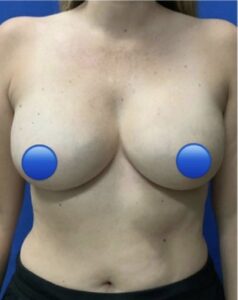 Before Image: Breast Explant Surgery: 5 Weeks Post Op