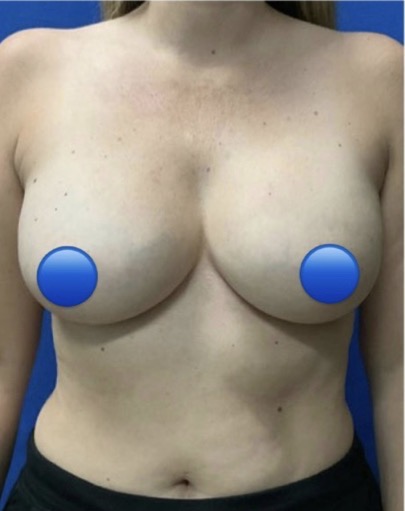 Before Image: Breast Explant Surgery: 5 Weeks Post Op - front