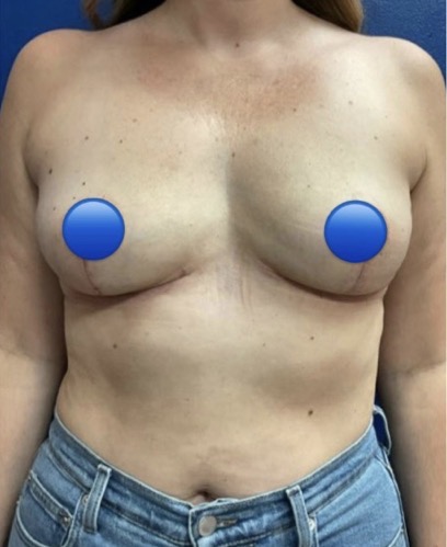After Image: Breast Explant Surgery: 5 Weeks Post Op - front