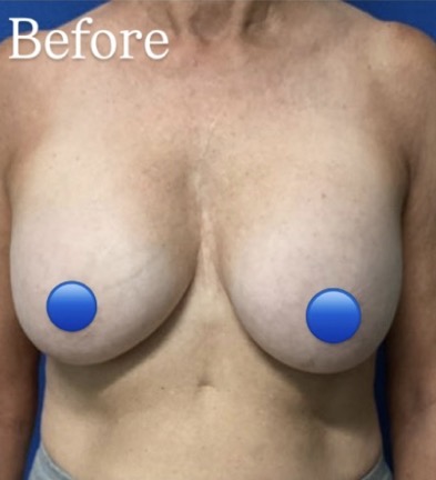 Before Image: Breast Explant Surgery: 7 Weeks Post Op - front