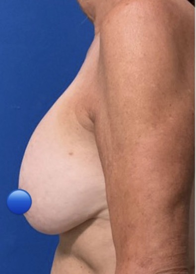 Before Image: Breast Explant Surgery: 7 Weeks Post Op - left-side