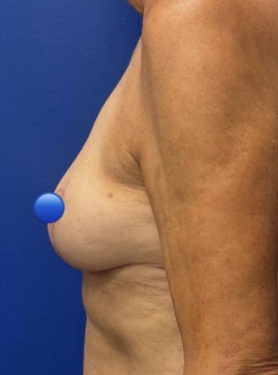 After Image: Breast Explant Surgery: 7 Weeks Post Op - left-side