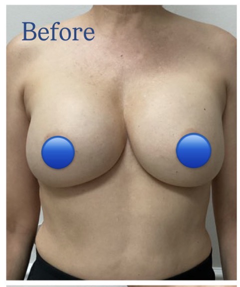 Before Image: Breast Explant Surgery: 6 Weeks Post Op - front