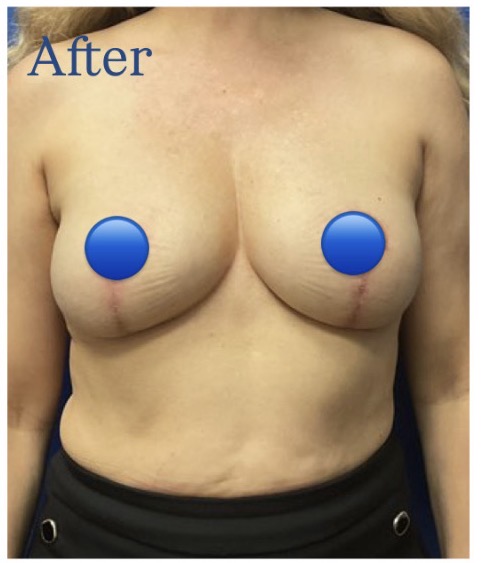 After Image: Breast Explant Surgery: 6 Weeks Post Op - front