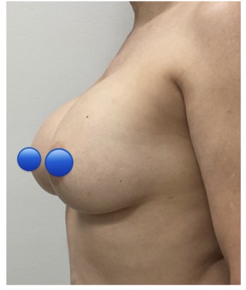 Before Image: Breast Explant Surgery: 6 Weeks Post Op - left-front-oblique