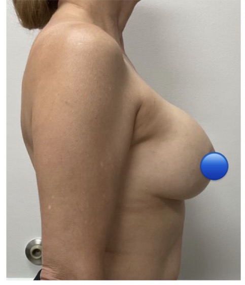 Before Image: Breast Explant Surgery: 6 Weeks Post Op - right-side