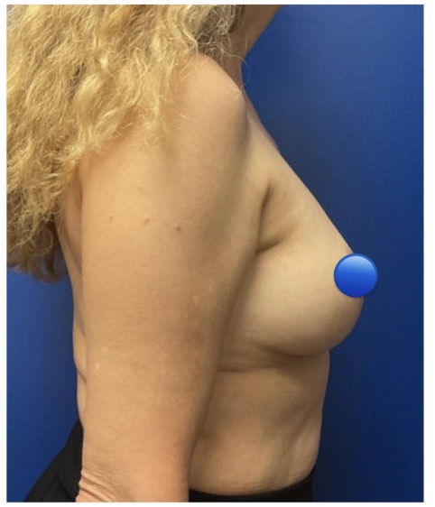After Image: Breast Explant Surgery: 6 Weeks Post Op - right-side