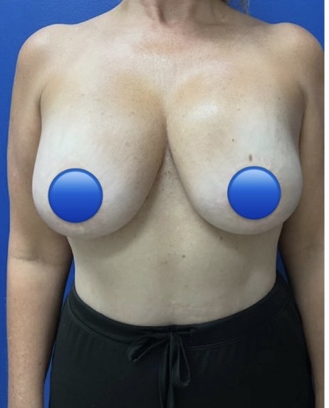 Before Image: Breast Explant Surgery: 1 Month Post Op - front