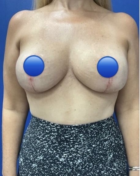 After Image: Breast Explant Surgery: 1 Month Post Op - front