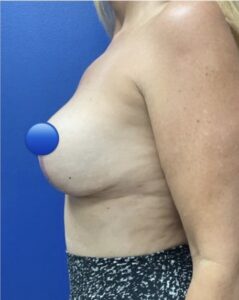 After Image: Breast Explant Surgery: 1 Month Post Op