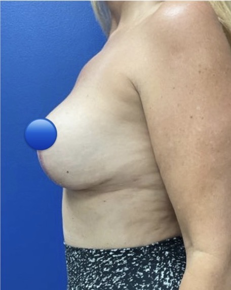 After Image: Breast Explant Surgery: 1 Month Post Op - left-side