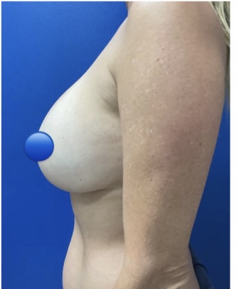 Before Image: Breast Explant Surgery: 1 Month Post Op - left-side