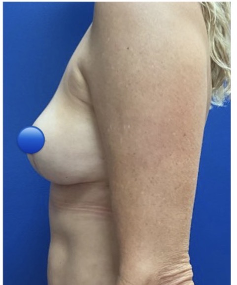 After Image: Breast Explant Surgery: 1 Month Post Op - left-side