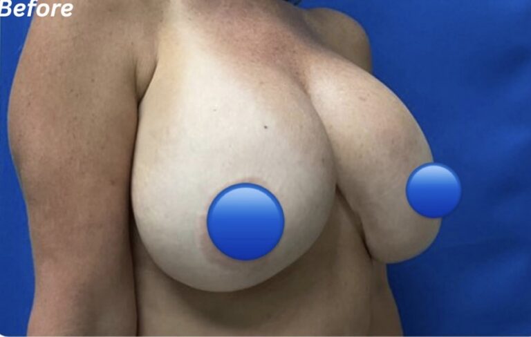 Before Image: Breast Explant Surgery: 1 Year Post Op - 