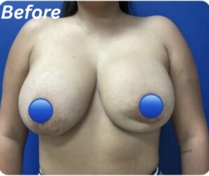 Before Image: Breast Explant Surgery: 1 Month Post Op