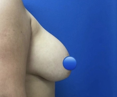 Before Image: Breast Explant Surgery: 1 Month Post Op - right-side