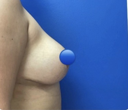 After Image: Breast Explant Surgery: 1 Month Post Op - right-side