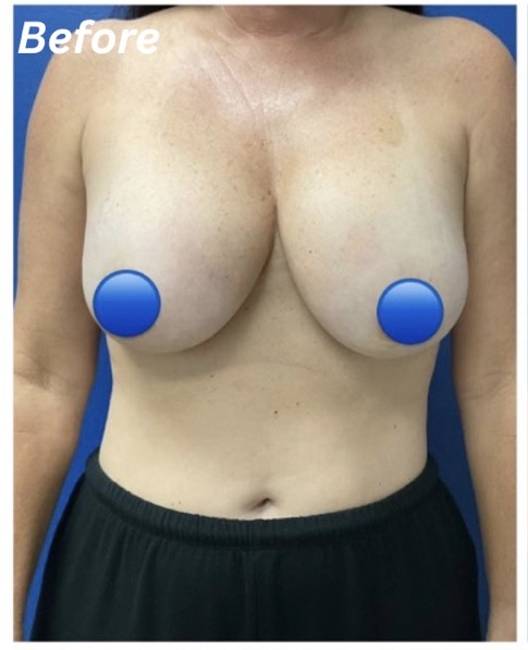 Before Image: Breast Explant Surgery: 6 Weeks Post Op - front