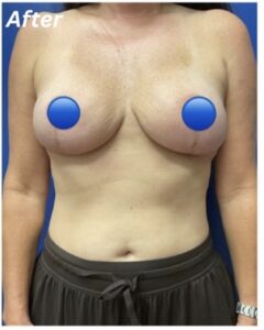 After Image: Breast Explant Surgery: 6 Weeks Post Op