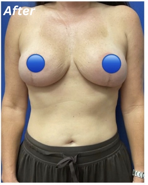 After Image: Breast Explant Surgery: 6 Weeks Post Op - front